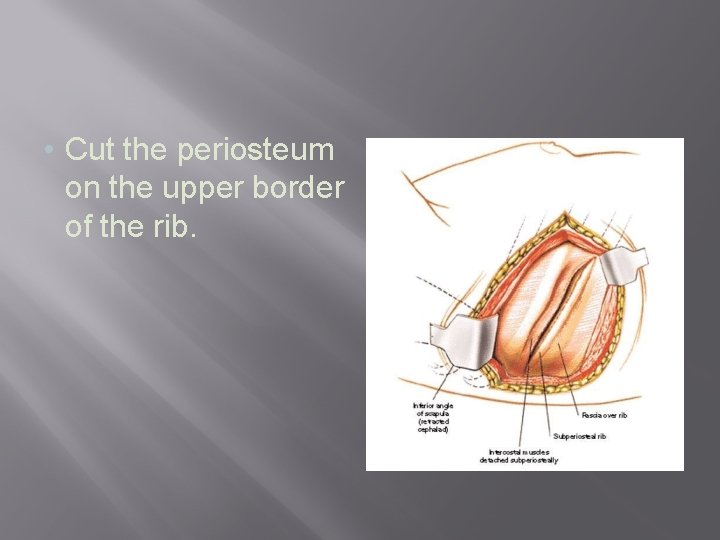  • Cut the periosteum on the upper border of the rib. 