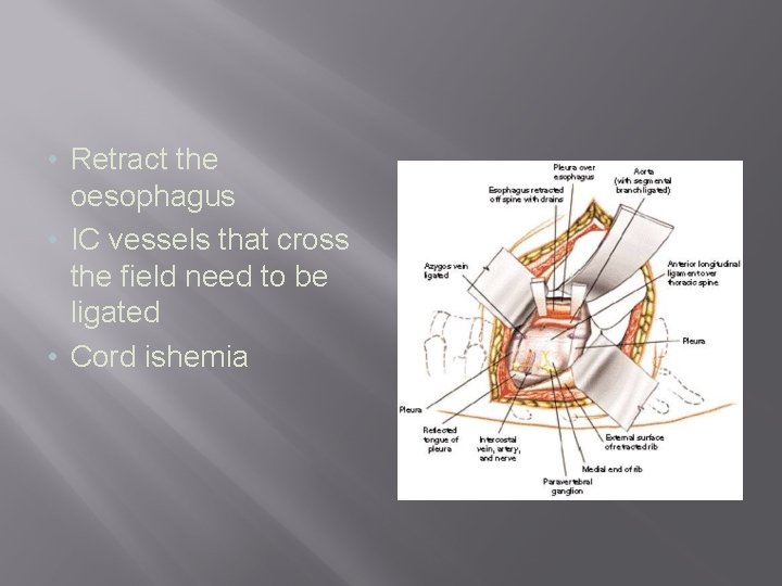  • Retract the oesophagus • IC vessels that cross the field need to