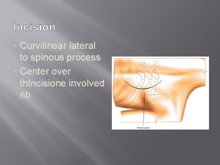  • Curvilinear lateral to spinous process • Center over th. Incisione involved rib