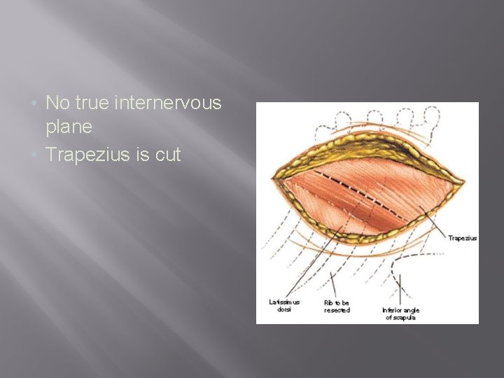  • No true internervous plane • Trapezius is cut 
