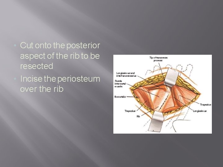  • Cut onto the posterior aspect of the rib to be resected •