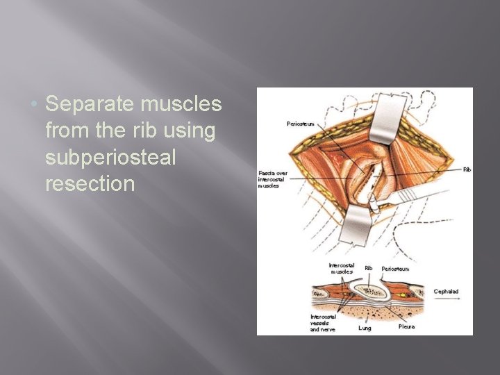  • Separate muscles from the rib using subperiosteal resection 