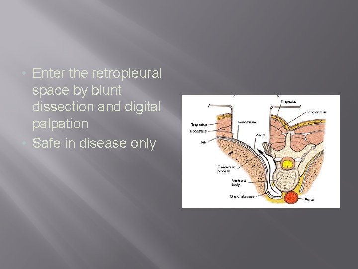  • Enter the retropleural space by blunt dissection and digital palpation • Safe