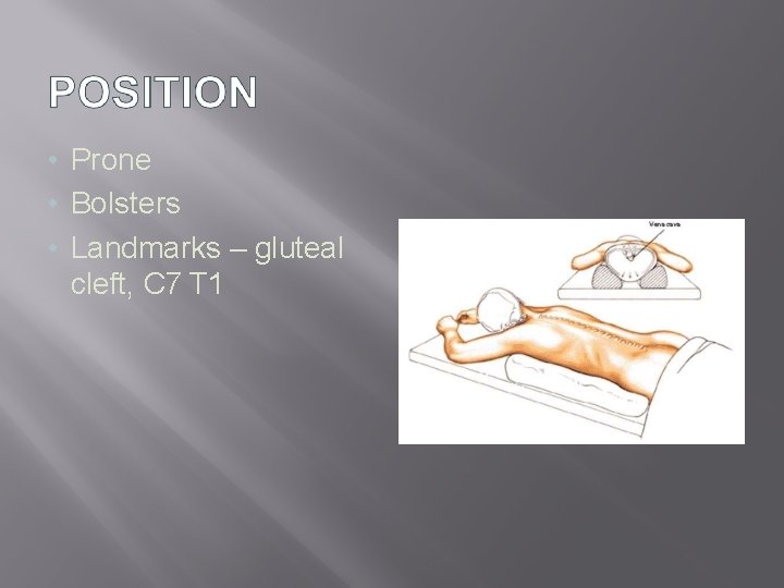  • Prone • Bolsters • Landmarks – gluteal cleft, C 7 T 1