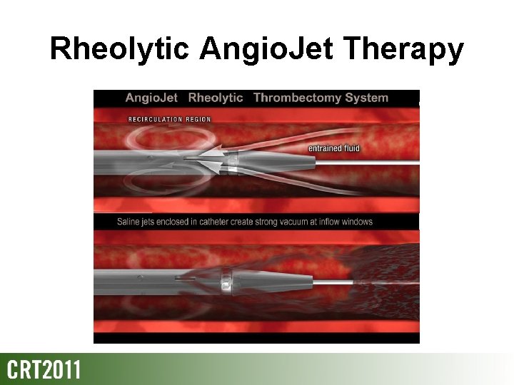 Rheolytic Angio. Jet Therapy 