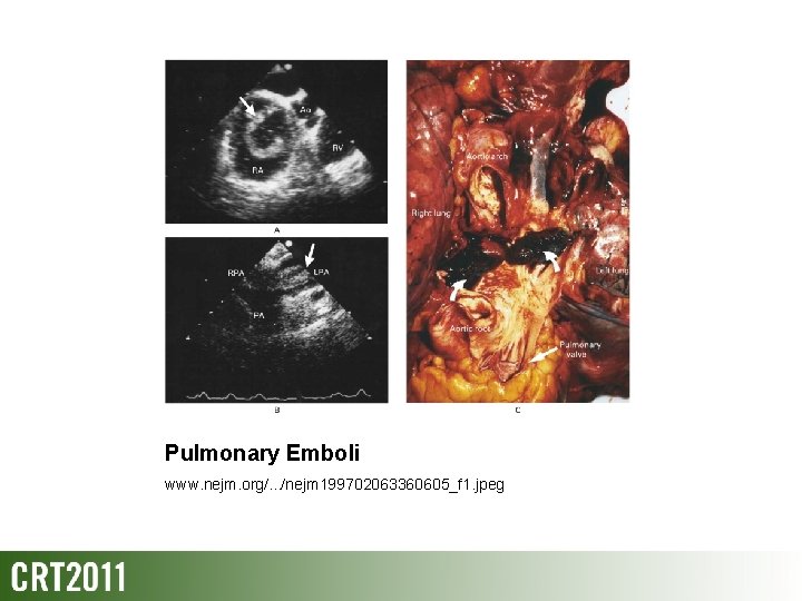 Pulmonary Emboli www. nejm. org/. . . /nejm 199702063360605_f 1. jpeg 