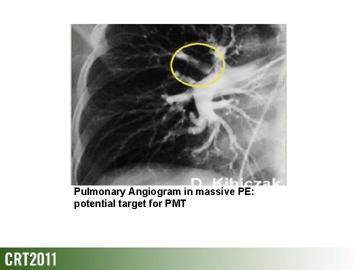 Pulmonary Angiogram in massive PE: potential target for PMT 
