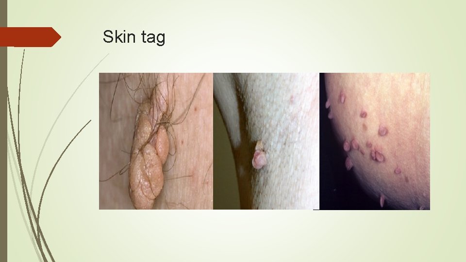 Skin tag 