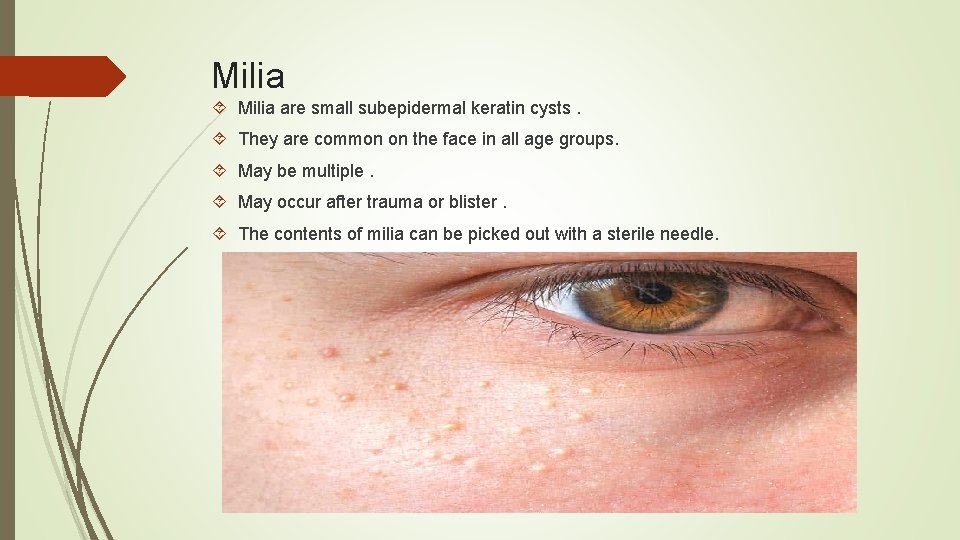 Milia are small subepidermal keratin cysts. They are common on the face in all