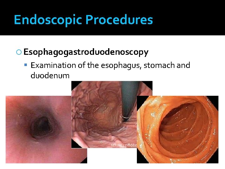 Endoscopic Procedures Esophagogastroduodenoscopy Examination of the esophagus, stomach and duodenum 
