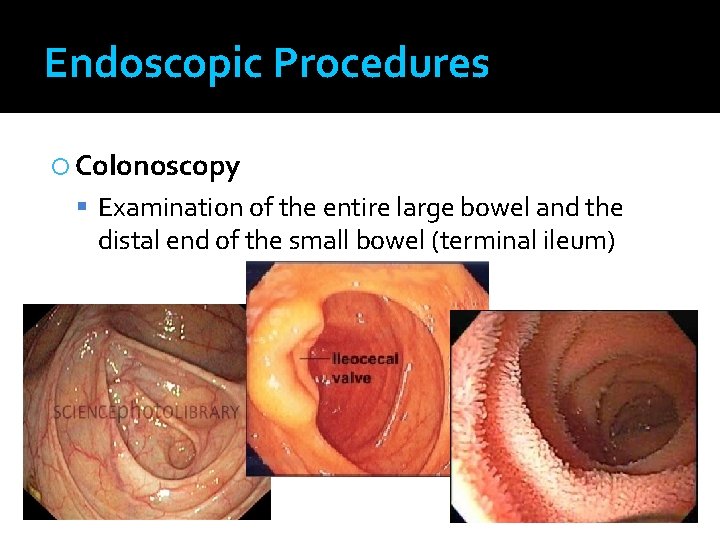 Endoscopic Procedures Colonoscopy Examination of the entire large bowel and the distal end of