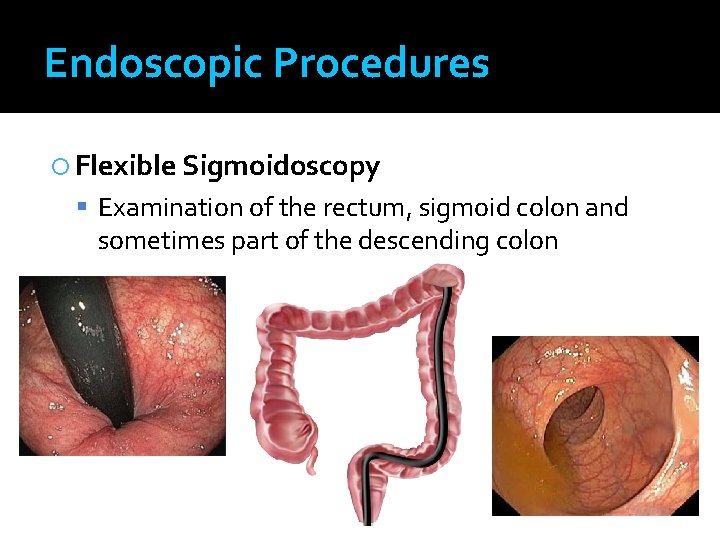Endoscopic Procedures Flexible Sigmoidoscopy Examination of the rectum, sigmoid colon and sometimes part of