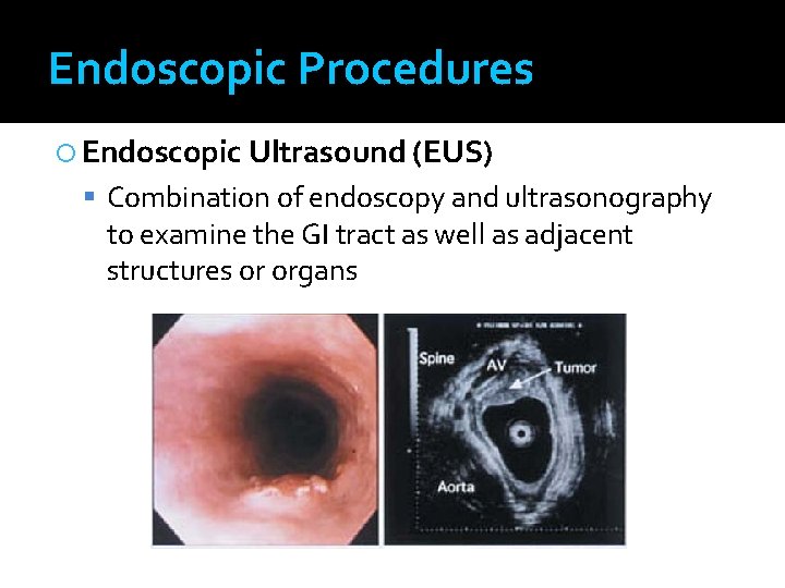 Endoscopic Procedures Endoscopic Ultrasound (EUS) Combination of endoscopy and ultrasonography to examine the GI