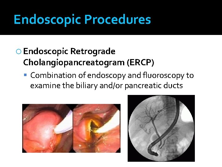 Endoscopic Procedures Endoscopic Retrograde Cholangiopancreatogram (ERCP) Combination of endoscopy and fluoroscopy to examine the