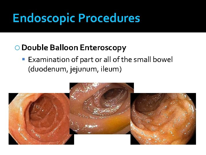 Endoscopic Procedures Double Balloon Enteroscopy Examination of part or all of the small bowel