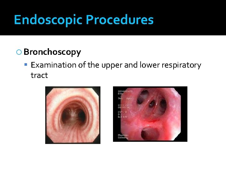 Endoscopic Procedures Bronchoscopy Examination of the upper and lower respiratory tract 