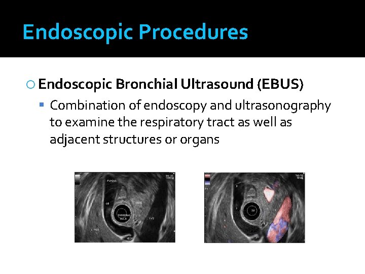 Endoscopic Procedures Endoscopic Bronchial Ultrasound (EBUS) Combination of endoscopy and ultrasonography to examine the