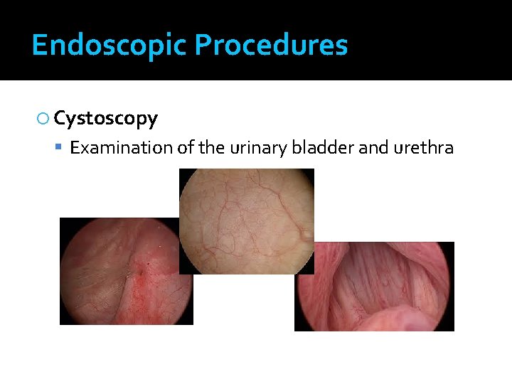 Endoscopic Procedures Cystoscopy Examination of the urinary bladder and urethra 