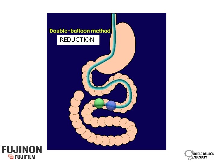 REDUCTION 