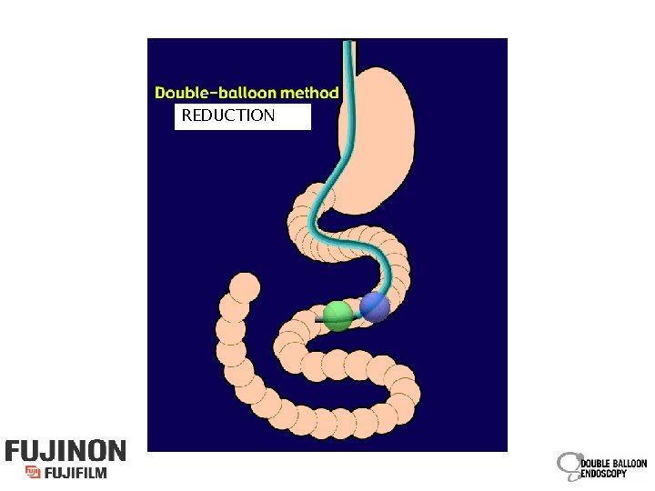 REDUCTION 