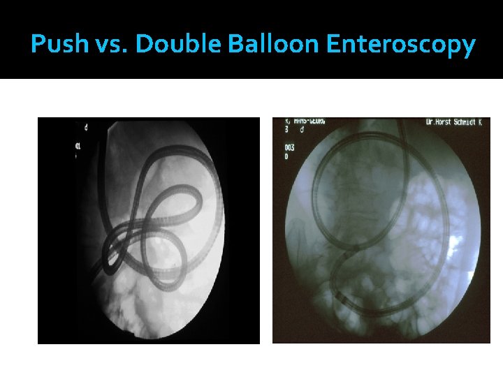 Push vs. Double Balloon Enteroscopy 