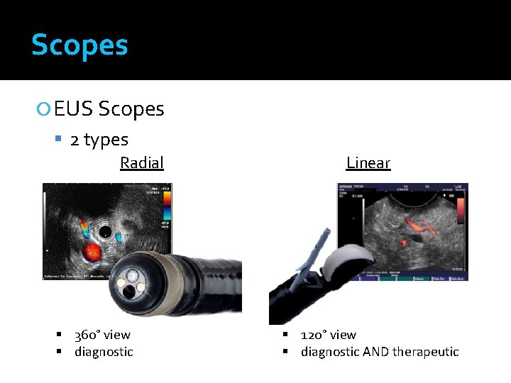 Scopes EUS Scopes 2 types Radial 360° view diagnostic Linear 120° view diagnostic AND