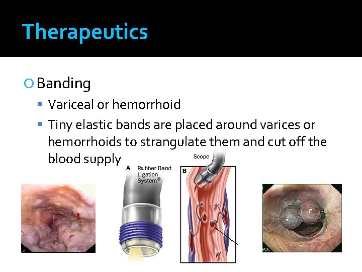 Therapeutics Banding Variceal or hemorrhoid Tiny elastic bands are placed around varices or hemorrhoids