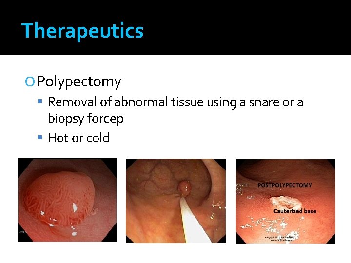 Therapeutics Polypectomy Removal of abnormal tissue using a snare or a biopsy forcep Hot