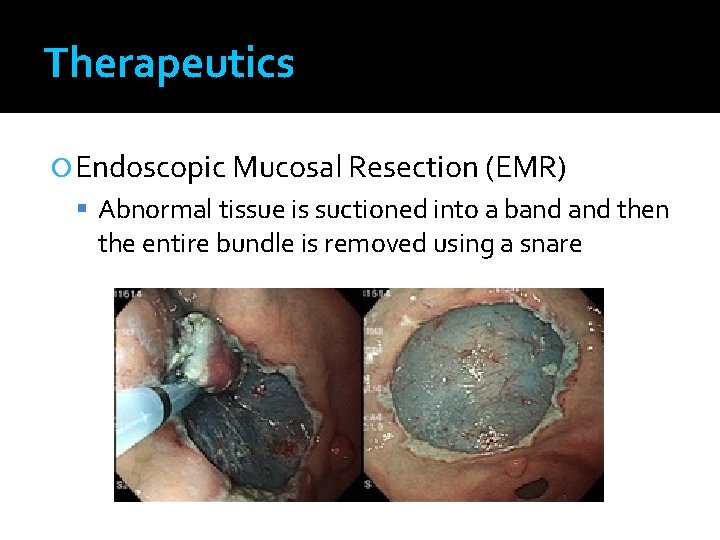 Therapeutics Endoscopic Mucosal Resection (EMR) Abnormal tissue is suctioned into a band then the