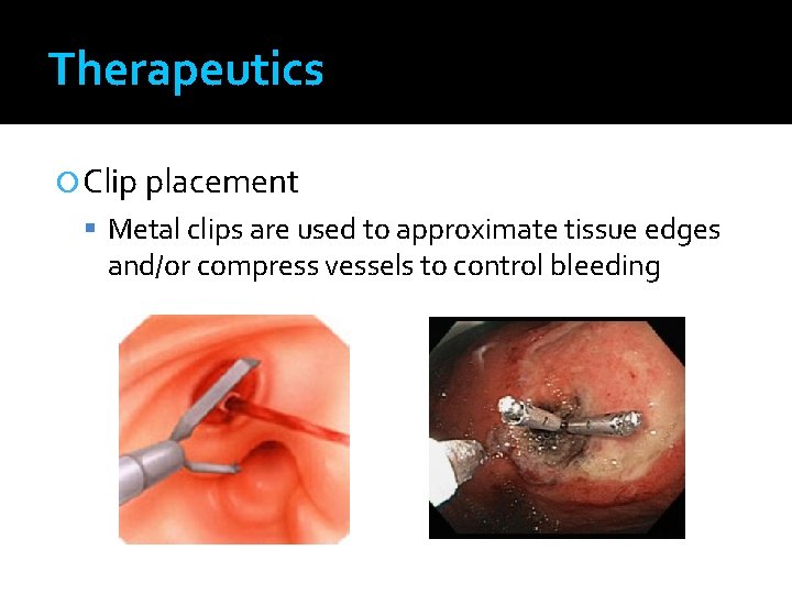 Therapeutics Clip placement Metal clips are used to approximate tissue edges and/or compress vessels