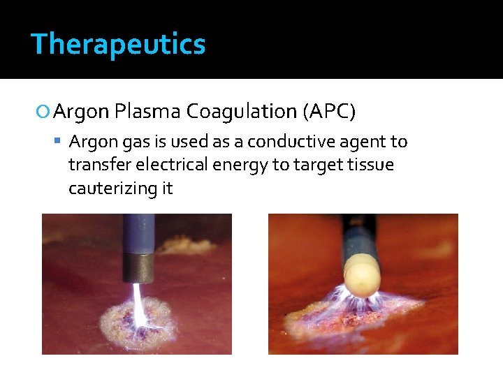 Therapeutics Argon Plasma Coagulation (APC) Argon gas is used as a conductive agent to