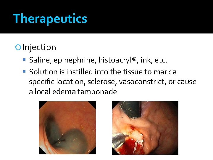 Therapeutics Injection Saline, epinephrine, histoacryl®, ink, etc. Solution is instilled into the tissue to