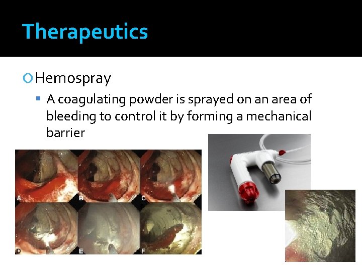 Therapeutics Hemospray A coagulating powder is sprayed on an area of bleeding to control