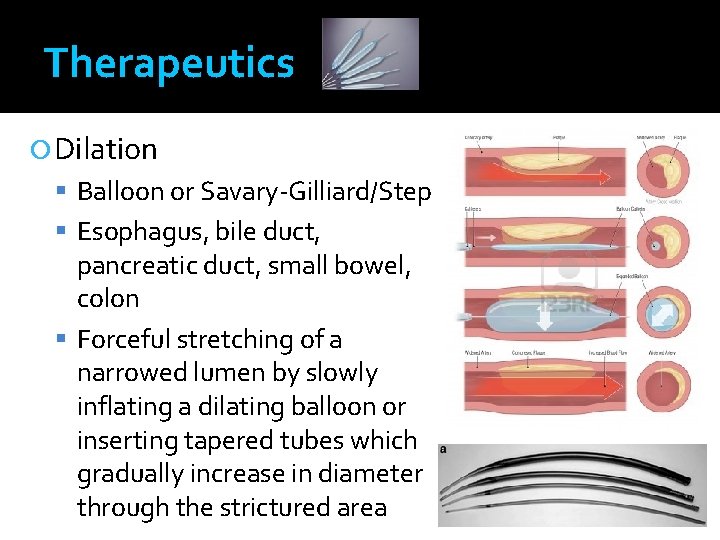 Therapeutics Dilation Balloon or Savary-Gilliard/Step Esophagus, bile duct, pancreatic duct, small bowel, colon Forceful