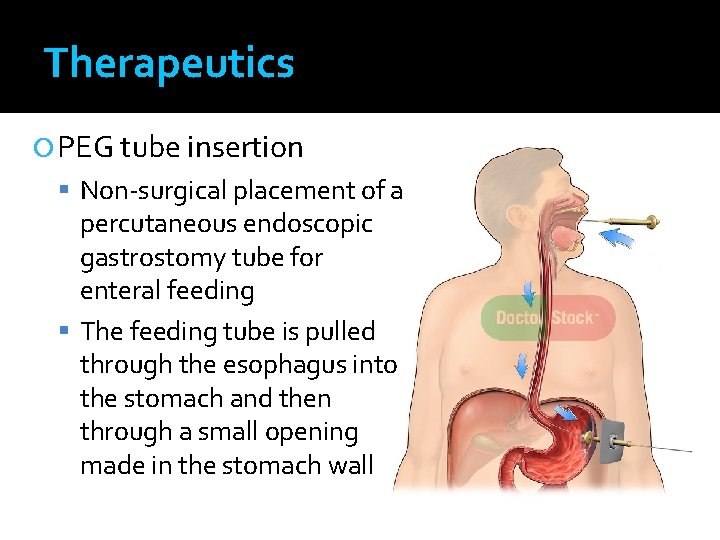 Therapeutics PEG tube insertion Non-surgical placement of a percutaneous endoscopic gastrostomy tube for enteral