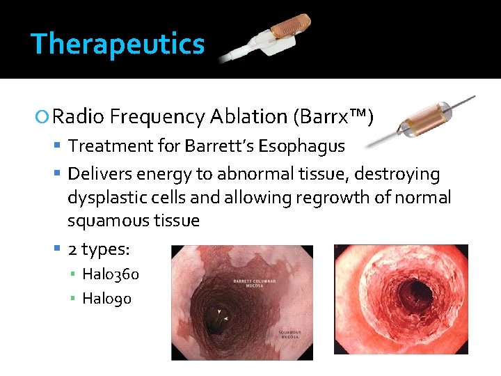 Therapeutics Radio Frequency Ablation (Barrx™) Treatment for Barrett’s Esophagus Delivers energy to abnormal tissue,
