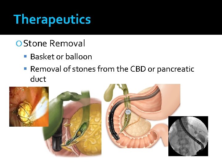Therapeutics Stone Removal Basket or balloon Removal of stones from the CBD or pancreatic