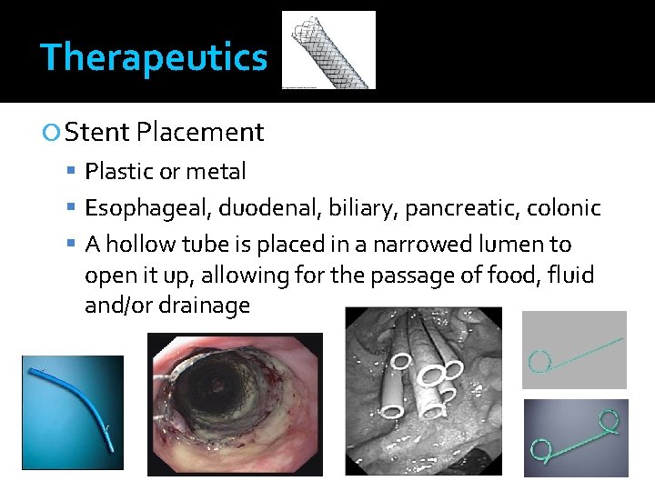 Therapeutics Stent Placement Plastic or metal Esophageal, duodenal, biliary, pancreatic, colonic A hollow tube