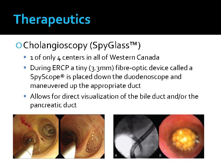 Therapeutics Cholangioscopy (Spy. Glass™) 1 of only 4 centers in all of Western Canada