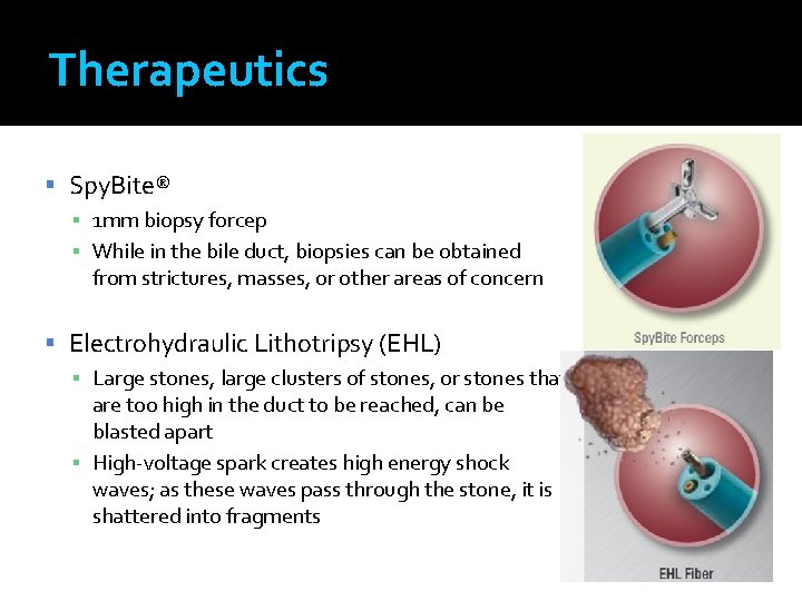 Therapeutics Spy. Bite® ▪ 1 mm biopsy forcep ▪ While in the bile duct,