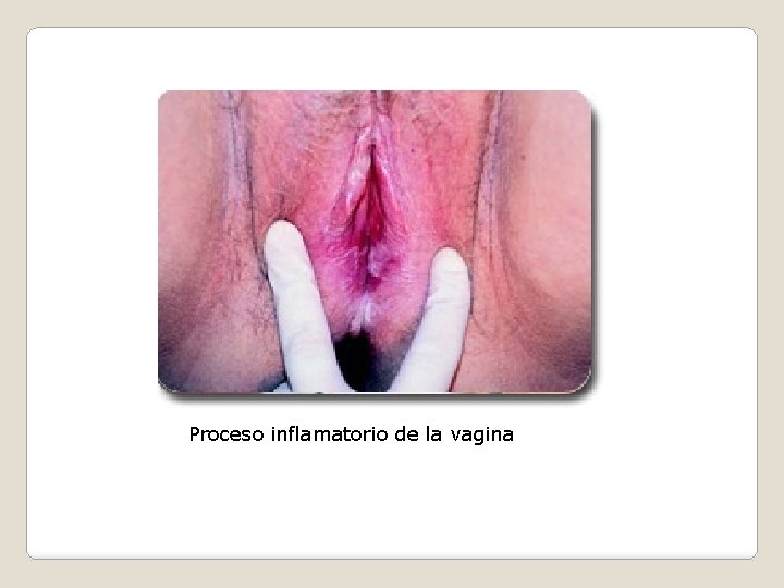 Proceso inflamatorio de la vagina 