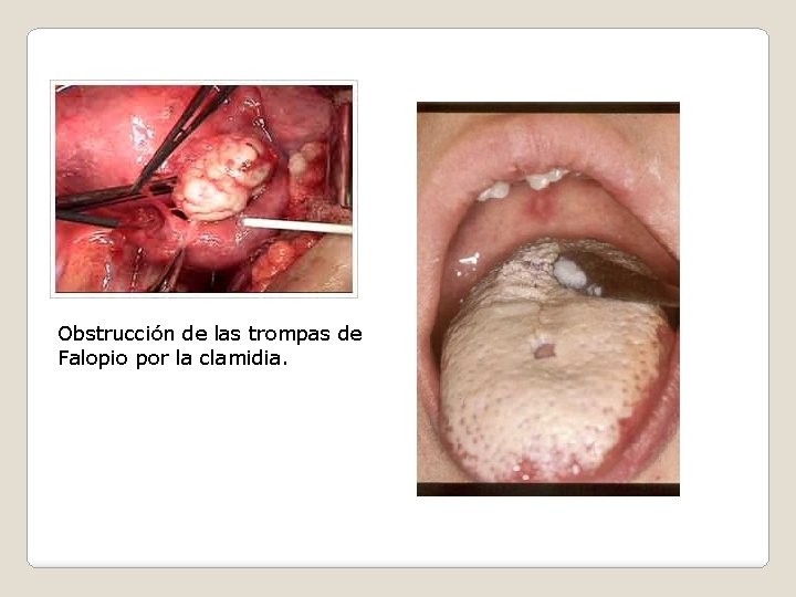 Obstrucción de las trompas de Falopio por la clamidia. 