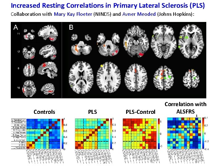 Increased Resting Correlations in Primary Lateral Sclerosis (PLS) Collaboration with Mary Kay Floeter (NINDS)