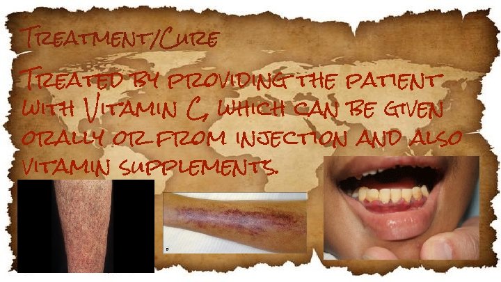 Treatment/Cure Treated by providing the patient with Vitamin C, which can be given orally
