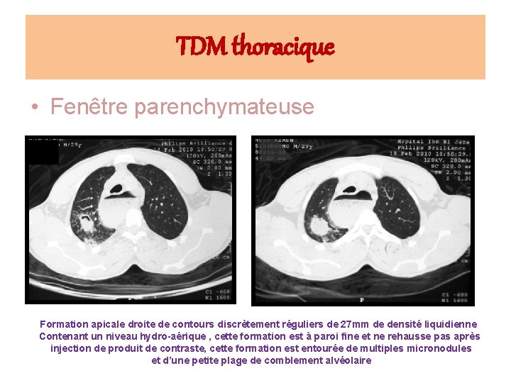 TDM thoracique • Fenêtre parenchymateuse Formation apicale droite de contours discrètement réguliers de 27