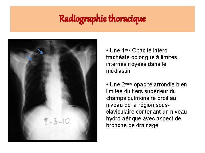 Radiographie thoracique • Une 1ère Opacité latérotrachéale oblongue à limites internes noyées dans le