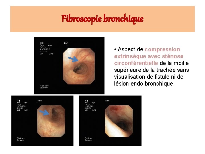 Fibroscopie bronchique • Aspect de compression extrinsèque avec sténose circonférentielle de la moitié supérieure