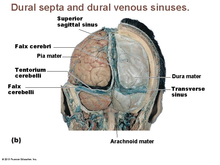 Dural septa and dural venous sinuses. Superior sagittal sinus Falx cerebri Pia mater Tentorium