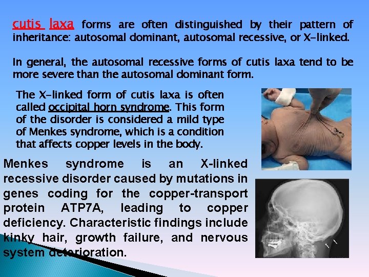 cutis laxa forms are often distinguished by their pattern of inheritance: autosomal dominant, autosomal