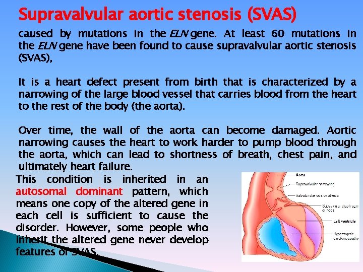 Supravalvular aortic stenosis (SVAS) caused by mutations in the ELN gene. At least 60
